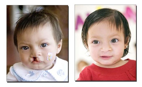 OpSmile_Britany_B&A